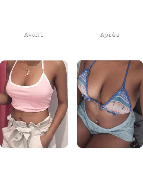 Cure prise de forme